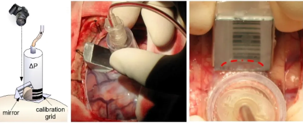Fig. 1. Light suction device used to measure brain elasticity: Schematic view (a), intra- intra-operative use (b), photo of the aspirated tissue reflected in the mirror (c) - (from [14])