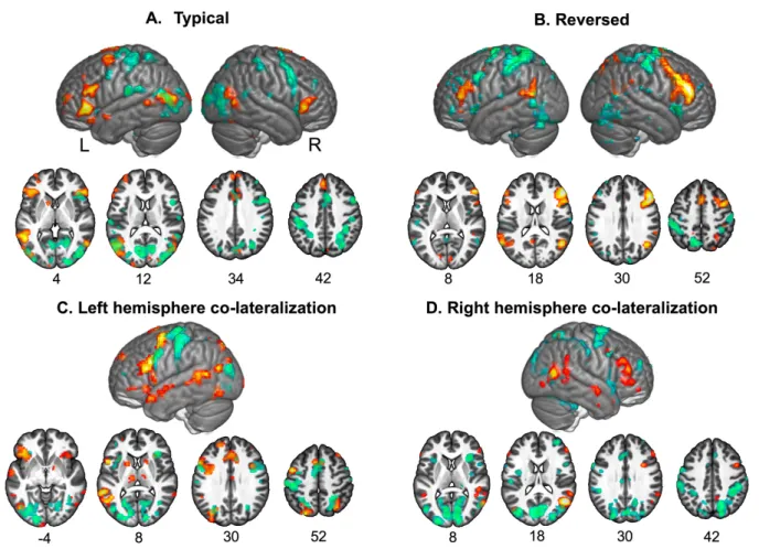 Fig. 1. Individual BOLD contrast maps illustrating at the voxel level different “phenotypes in hemispheric functional segregation” described by Vingerhoets for language and attention [7]