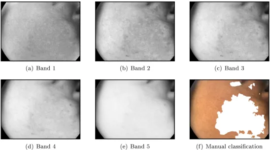 Figure 2: Spectral bands of the reduced data cube by projection pursuit (a-e), and a manual classication of the hyper-pigmentation (f).