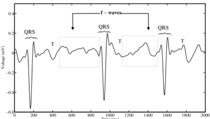 Fig. 1: Example of ECG recording during AF and its characteristic waves on the lead V 1 