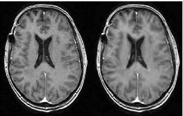 Figure 1.7: Image slice without (left) and with (right) compression (compression ratio = 64)