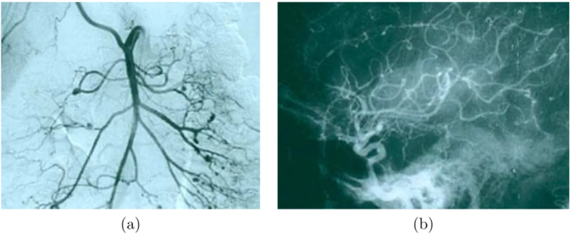 Fig. 1.2 – Les vaisseaux sanguins - (a) angiogramme abdominal - (b) angiogramme du syst`eme nerveux central.