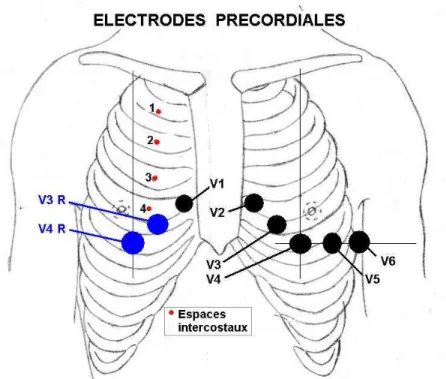 Figure 2.7  Emplacement des électrodes précordiales : V1 à V6 (extrait de [1]).