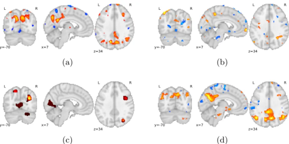 Fig. 3: Maps of AD discriminative spatial patterns extracted from : (a) the FDG- FDG-PET model used as prior