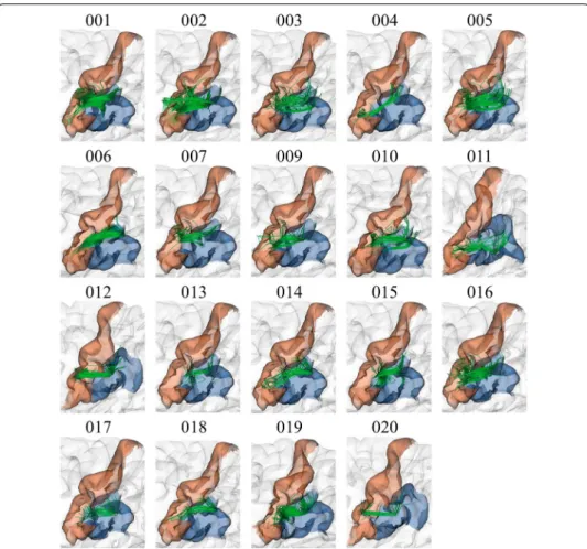 Fig. 10  Bundle lh_PoC‑SM_2, with the highest reproducibility in all subjects. The results show good  reproducibility among subjects, appearing in 19 of the 20 subjects for the QB method with 12 mm threshold