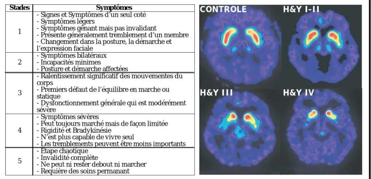 Figure 6 : Echelle de Hoehn et Yahr en parallèle avec des  scanners de patients  