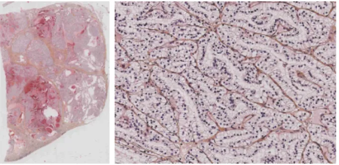 Figure 1: One slice of a tumor: (left) the whole slice;