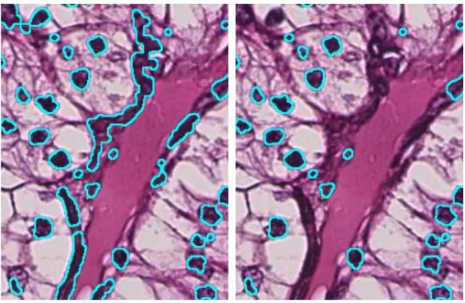 Figure 6: Nuclei removal in the V channel. Before (left) and after (right) removal. Images are 300×250 pixels.