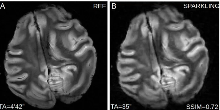 Figure 2:  T2*-weighted  GRE  transversal  slice  of  the ex vivo baboon brain  is  displayed  for  A) the full Cartesian reference sampling lasting 4 minutes and 42 seconds and B) the presented 8-fold undersampled SPARKLING  trajectories  lasting only  35