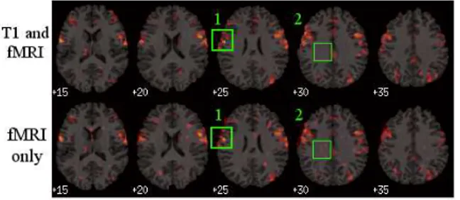 Fig. 2. The estimated template on real data. The yellow/red colors correspond to high/low probability of the activation for the computation task.