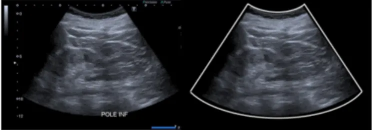 Fig. 1: Left picture shows the original image. One can see that the ultrasound fan area is limited to a conic section, and that a number of text and graphic elements are present