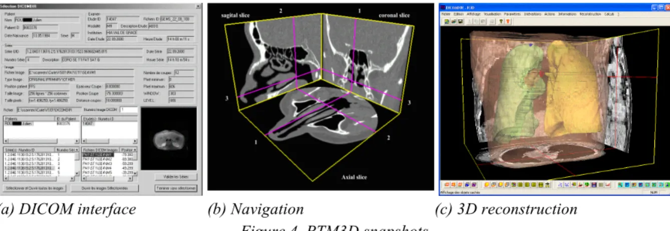 Figure 5. Augmented reality in surgical planning for percutaneous nephrolithotomy. 