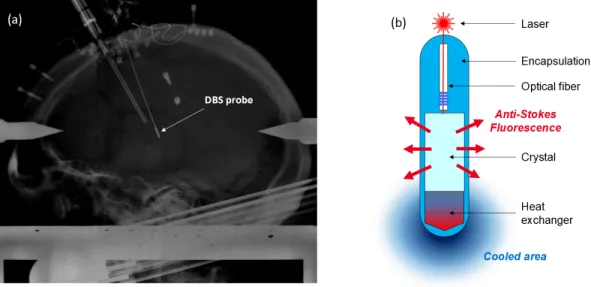 Figure 1. Alternative therapies for medically refractory epilepsy. (a) X-ray image of a surgical implantation performed at Clinatec (CEA Grenoble, France) of a deep brain stimulation (DBS) probe in the anterior nucleus of the thalamus