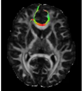 Figure 3: TBSS-based ROI projection �bers.