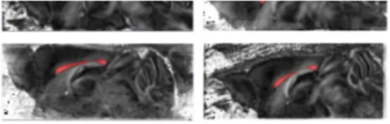 Figure 1. Illustrations of segmentation of the corpus callosum, colored in red from the FA map, of mice brains selected from the control group (top) and the cuprizone-treated group (bottom), respectively.