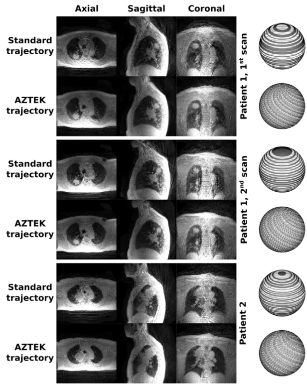 Figure  7:  Representation  of  ZTE  images  obtained  for  two  patients  with  lung  cancer,  the  first  one  being  scanned  twice,  through three orthogonal slices centered on the lung tumor. For each patient, the images acquired with the standard and