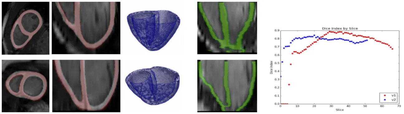 Fig. 3: Left: prediction (white), ground truth (red) and generated meshes for the two tested cases from STACOM