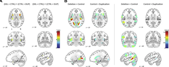 Figure 4. Differential and overlapping contribution of deletion and duplication to the regional gray matter volume differences