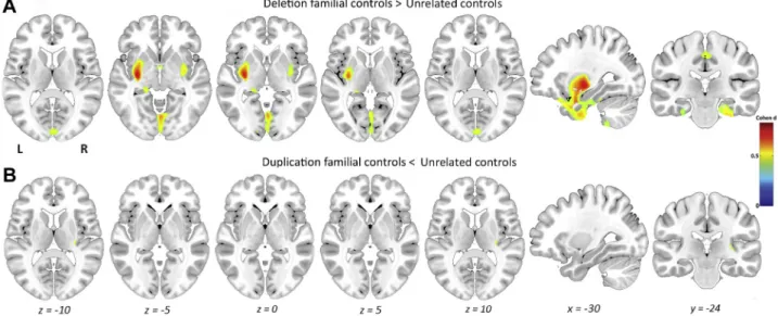 Figure 5. Contribution of familial control subjects to the regional gene dosage-dependent gray matter volume differences