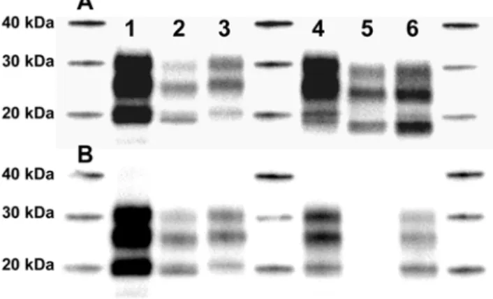 Figure 2. PrP res Profiles in iCJD Patients. PrP res (frontal cortex) was revealed in WB by antibodies Sha31 (A) and 12B2 (B)