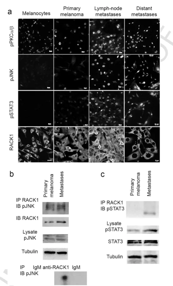 Fig. 5. JNK and STAT3 are oncogenic partners of RACK1 in ERK melanoma development.a, Fluorescent microscopy analysis of immunolabeling for pPKCα/β ⁠II , pJNK, pSTAT3 and RACK1 in Tyr::NRas ⁠⁎ ; Pax3 ⁠GFP/+ cells from each stage of melanoma progression