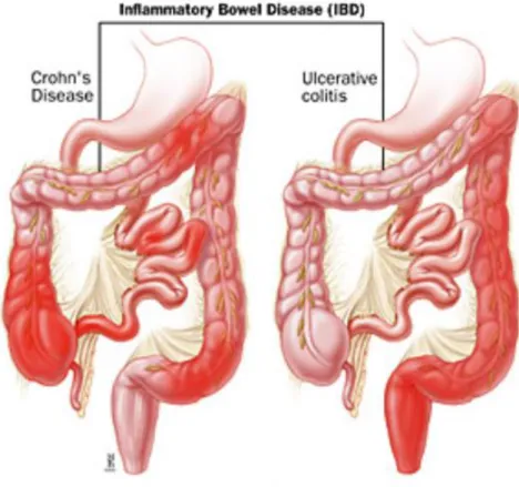 Figure 2 : Localisation des lésions intestinales dans la MC et la RCHU 