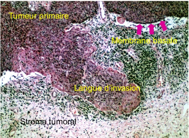 Figure 8: Invasion collective de cellules de carcinomes dans le stroma tumorale.