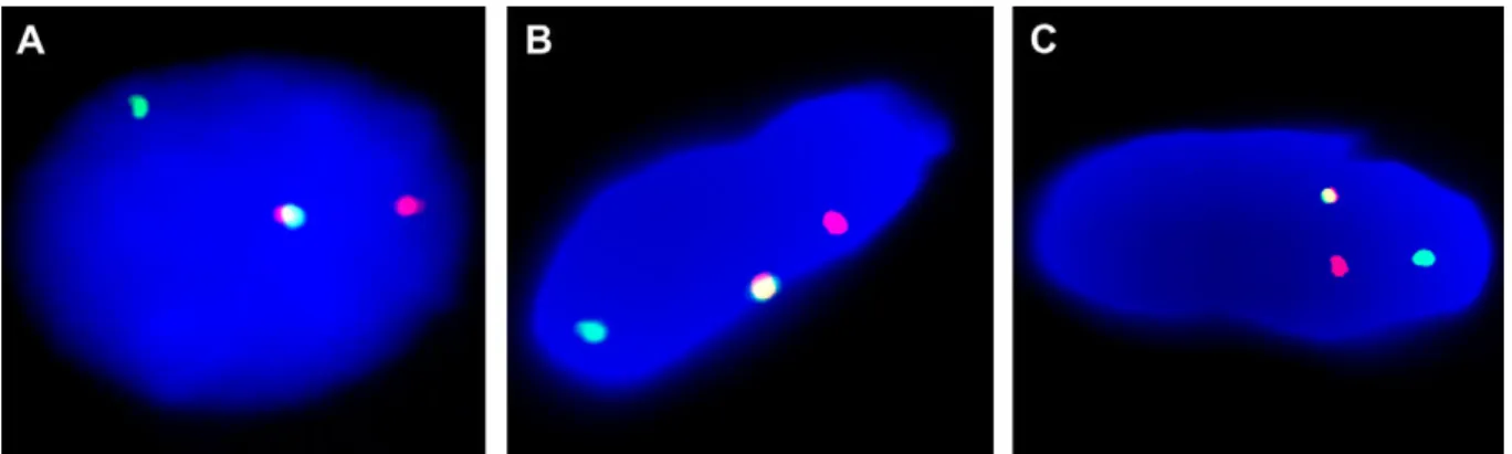 Fig. 2. Rearrangements of HMGA2 and NFIB identified by interphase fluorescence in situ hybridization analysis in a case of pediatric lipoma