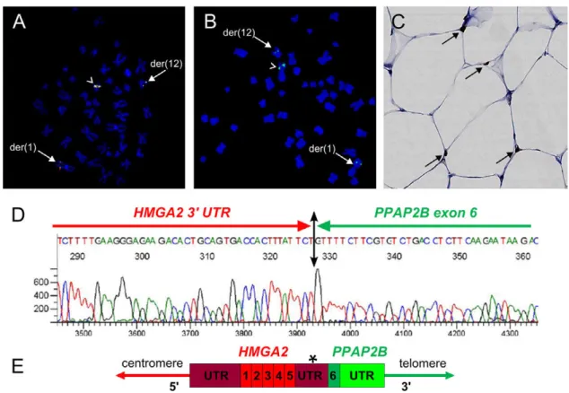 Figure 3. A-B: FISH analysis of HMGA2 (A) and PPAP2B (B) in case 10 using CTD-2240K5 (red signal) and RP11-427K2 (green signal) probes that span the same region of HMGA2 exons 4 and 5 and 3 0 UTR (A) and  CTD-2362O17 (green signal) that spans the PPAP2B ge