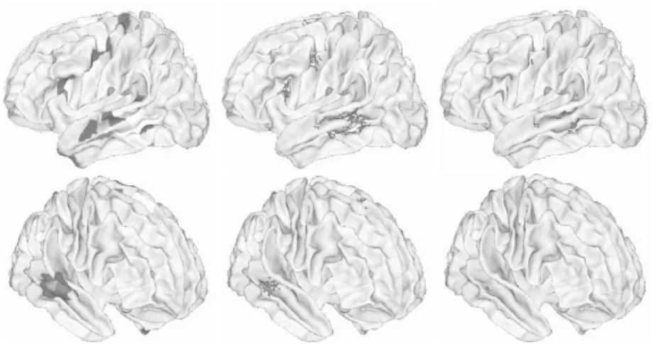 Fig. 2. Outcome of the parcel-based (left), cluster-based (middle) and node-based (right) random effects analyses in the left(top) and right (bottom) hemisphere