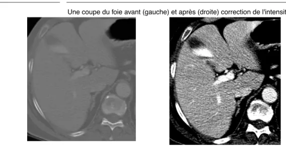 FIGURE 6. Une coupe du foie avant (gauche) et après (droite) correction de l'intensité