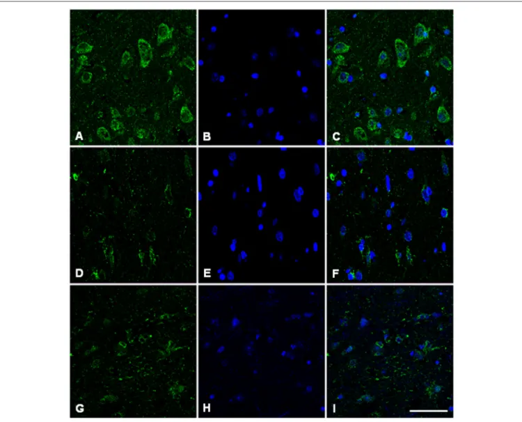 FIGURE 7 | Hemoglobin beta-chain in the frontal cortex of control subject (A–C), Alzheimer’s disease (D–F) and sCJD (G–I)