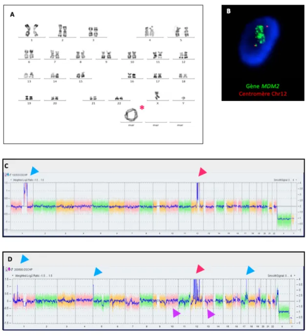 Figure  2.  Analyses  cytogénétiques  et  moléculaires  pour  la  détection  de  l’amplification  du  gène  MDM2