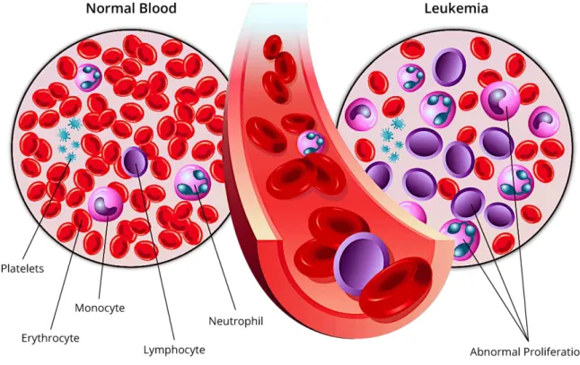Figure 2 : Composition cellulaire du tissu sanguin chez un sujet sain versus un patient