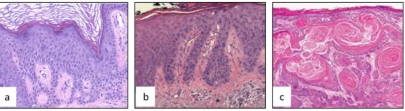 Figure 13: Histologic aspects of squamous Cell Carcinomas and their precursor  lesions