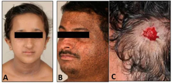 Figure 24 XP-C patients. (A)  lentigines on face in patients aged of 12 y; (B) extensive  pigmentary  changes,  patients  aged  of  38  y;  (C)  Site  of  excised  melanoma  in  the  temporal region of the head of a XP-C patient  (Fassihi, Sethi et al