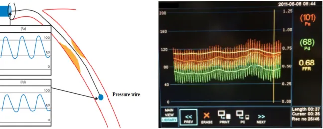 Figure 3.1: Left, representatif schema of the invasive FFR technique [16]. Right, a typical example of FFR measurement