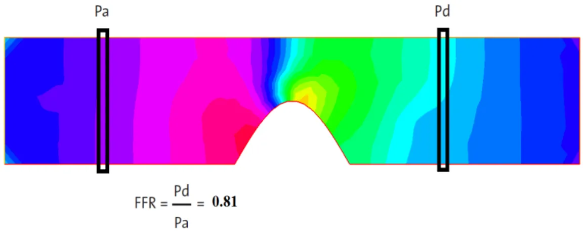 Figure 3.4: FFR calculation. In this case, the degree of stenosis is equal to 40% and the VFFR is equal to 0.81.