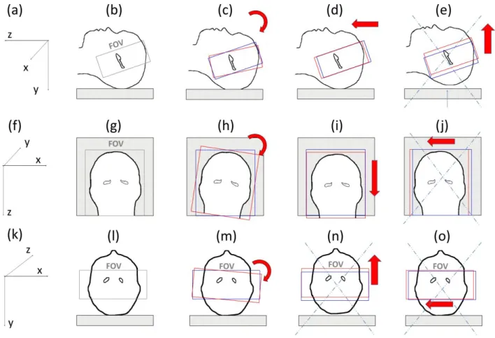 Figure 3: Possible motion inside the MRI system (top row: sagittal view, bottom row: coronal view) (a) xyz frame; (b)  position of the first slab perpendicular to the main axis of the hippocampus; (c) possible rotation along the x axis; (d)  possible trans