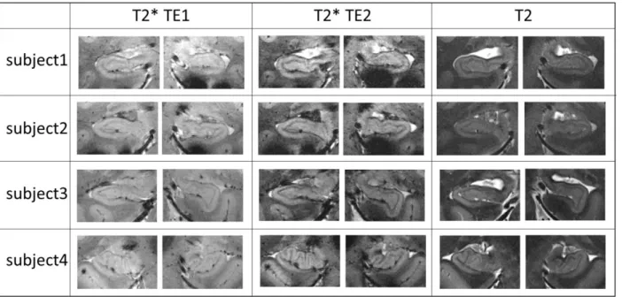 Figure 4: Visibility of the whole head of the hippocampi for four subjects and forT2*-weighting TE1= 16.41ms; T2*- T2*-weighting TE2=33.22ms; T2-T2*-weighting high-resolution slab