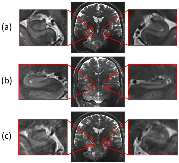 Figure 8: motion artefact: 3 levels of motion artefact: (a) no motion artefact, (b) medium motion artefact, (c) large motion  artefact