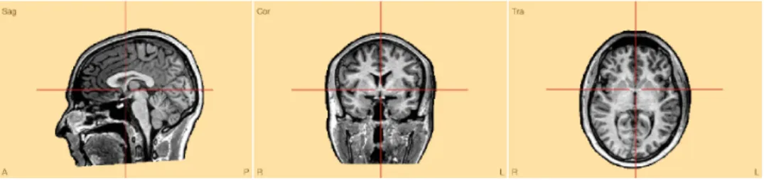Figure 1.11: Sagittal, coronal and transverse slices of T1-weighted MRI data.