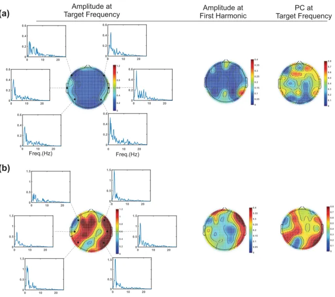 Figure 4.  Topographic maps presenting the peak amplitude of the auditory responses at the target frequency,  the first harmonic, and the PC at the target frequency for two neonates, at 31 weeks and 3 days GA (a) and 34  weeks and 1 day GA (b).