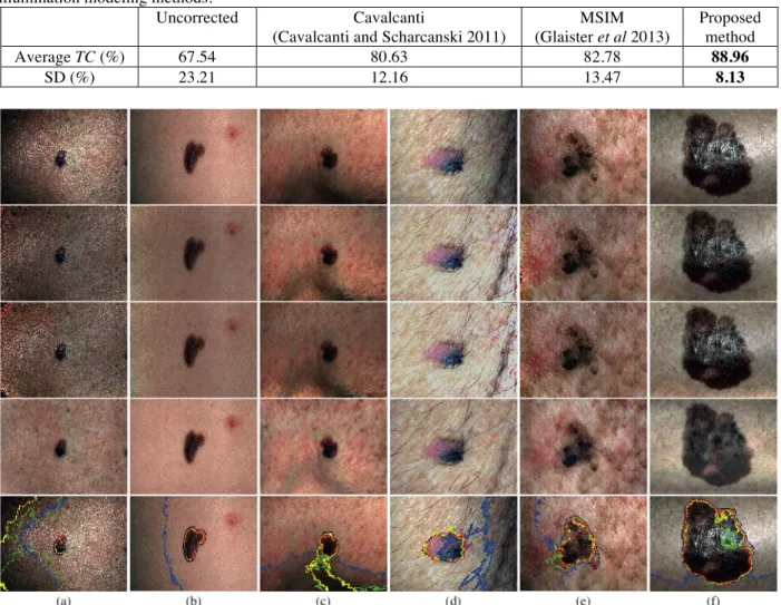 Table 1 shows the segmentation accuracy carried on uncorrected and corrected skin lesion images by  different algorithms
