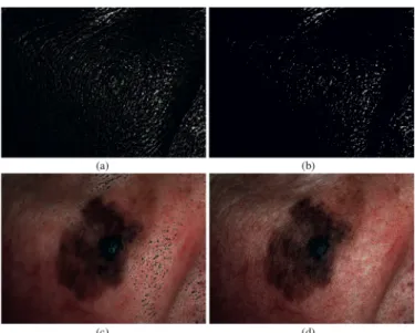 Figure 3 Specular reflection removal in skin image, taking the MM in figure 1 for example