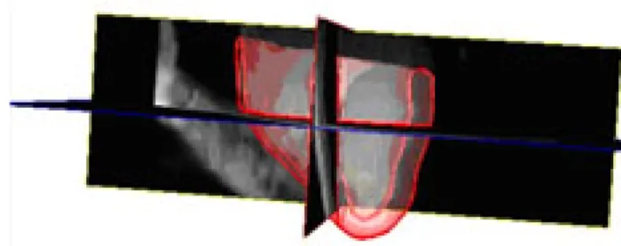 Fig. 8. Illustration of a segmentation result: heart model in red + 3D image
