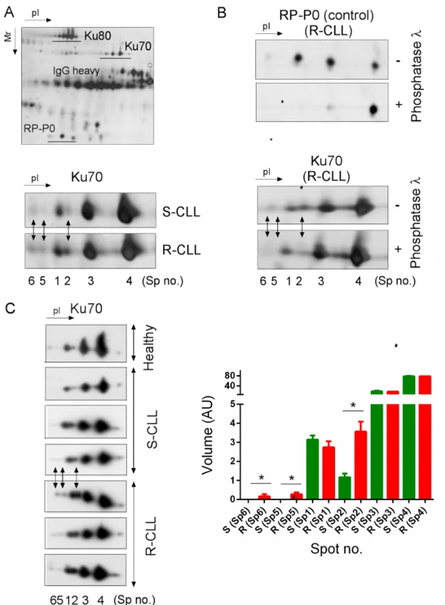 Figure 1: Preferential Ku70 phosphorylation in resistant CLL cells.  A. Ku heterodimer was immunopurified using Ku80 monoclonal  antibodies followed by 2D-PAGE separation