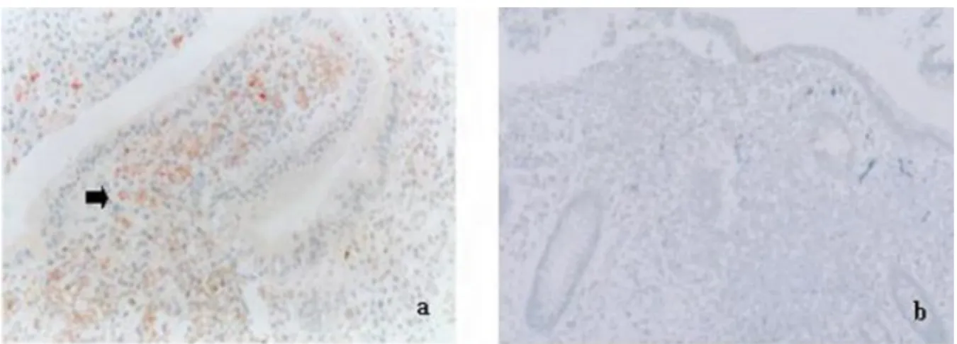Fig. 2. (a) IL-10 strong immunoreactivity in the lamina propria cells of patients with UC (n = 24) (arrow)
