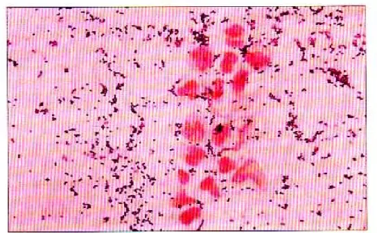 Figure  3   : Staphylococcus aureus : Coloration de Gram ; les cocci à Gram positif et les polynucléaires altérés colorés en rose (Gram, x1000) (D’après Hart T