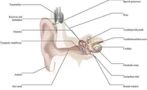 FIGURE 1: EAR ANATOMY AND COCHLEAR IMPLANT (ATTRIBUTED TO [5]) 